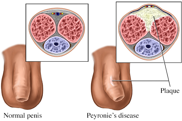 What is Peyronie's Disease