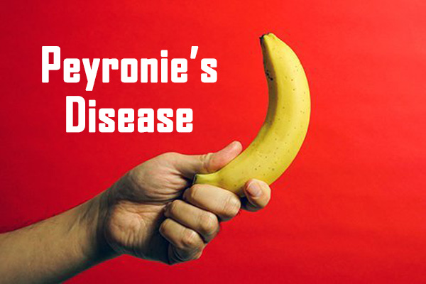 peyronie's disease