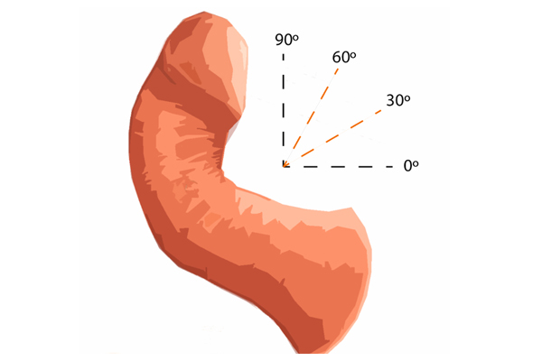 Peyronie disease