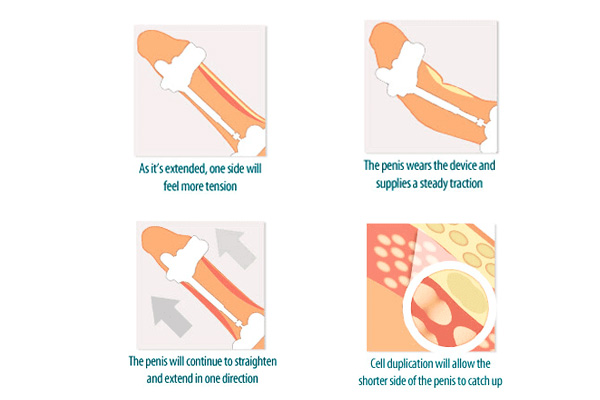 SizeGenetics device