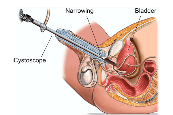 Penile Narrowing