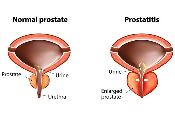 Prostatitis